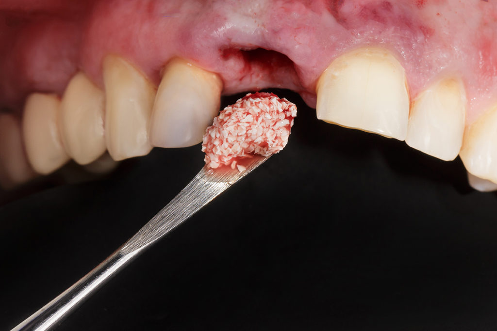 Dental Bone grafting procedure Hixson,TN