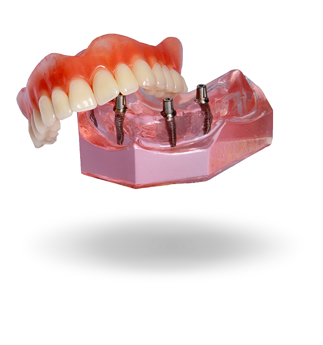 Implant denture model Hixson,TN
