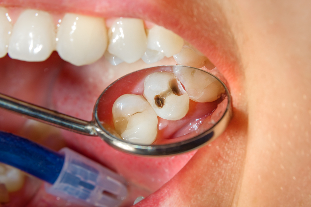 Dealing with Cavities